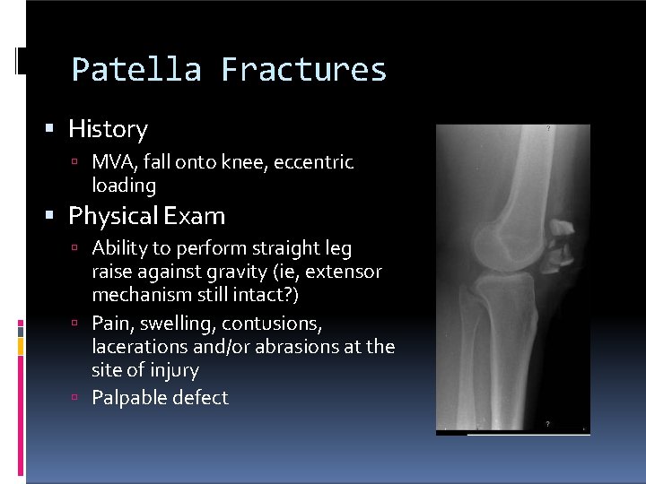 Patella Fractures History MVA, fall onto knee, eccentric loading Physical Exam Ability to perform