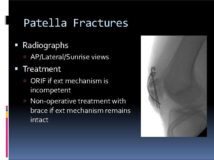 Patella Fractures Radiographs AP/Lateral/Sunrise views Treatment ORIF if ext mechanism is incompetent Non-operative treatment