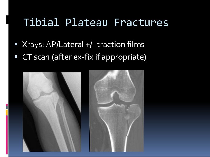 Tibial Plateau Fractures Xrays: AP/Lateral +/- traction films CT scan (after ex-fix if appropriate)