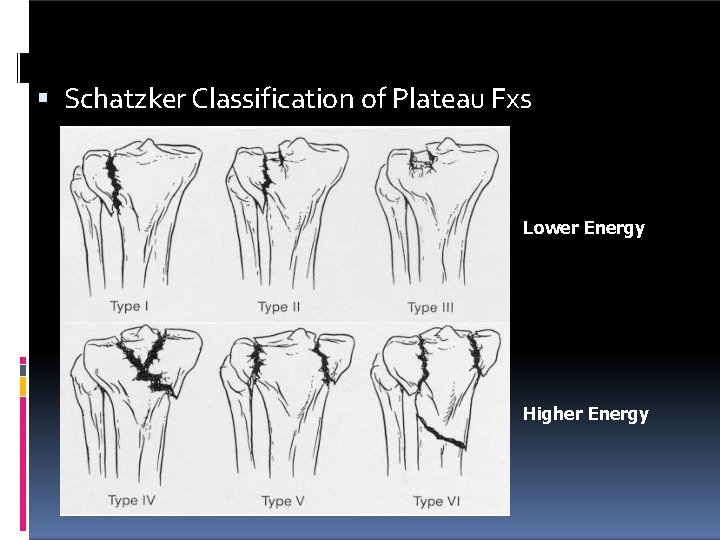  Schatzker Classification of Plateau Fxs Lower Energy Higher Energy 