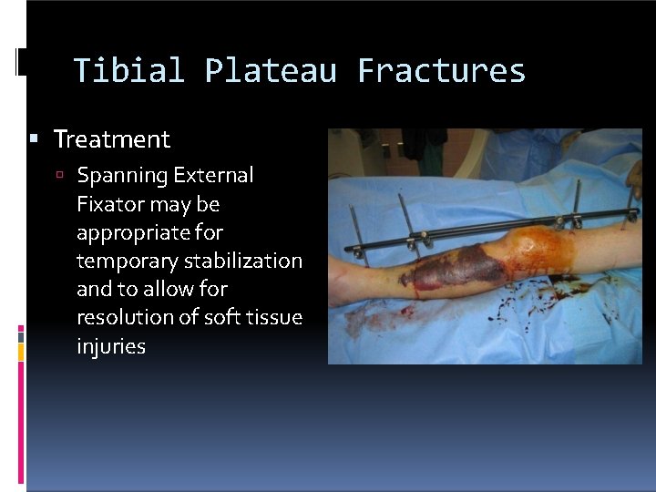 Tibial Plateau Fractures Treatment Spanning External Fixator may be appropriate for temporary stabilization and