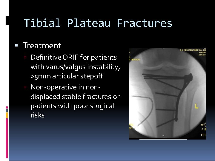 Tibial Plateau Fractures Treatment Definitive ORIF for patients with varus/valgus instability, >5 mm articular