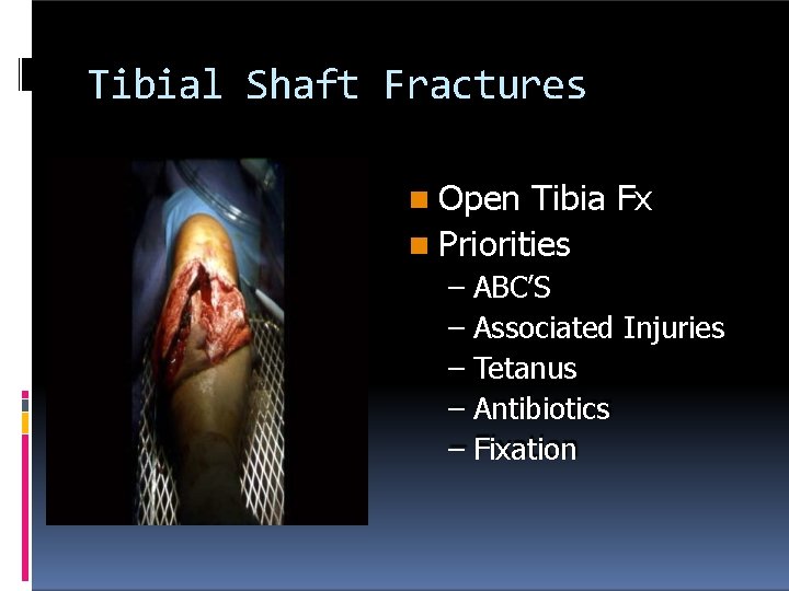 Tibial Shaft Fractures Open Tibia Fx Priorities – ABC’S – Associated Injuries – Tetanus