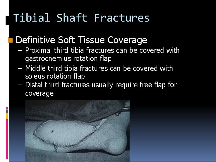 Tibial Shaft Fractures Definitive Soft Tissue Coverage – Proximal third tibia fractures can be