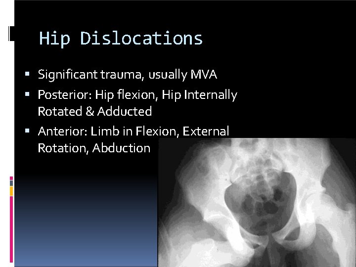 Hip Dislocations Significant trauma, usually MVA Posterior: Hip flexion, Hip Internally Rotated & Adducted