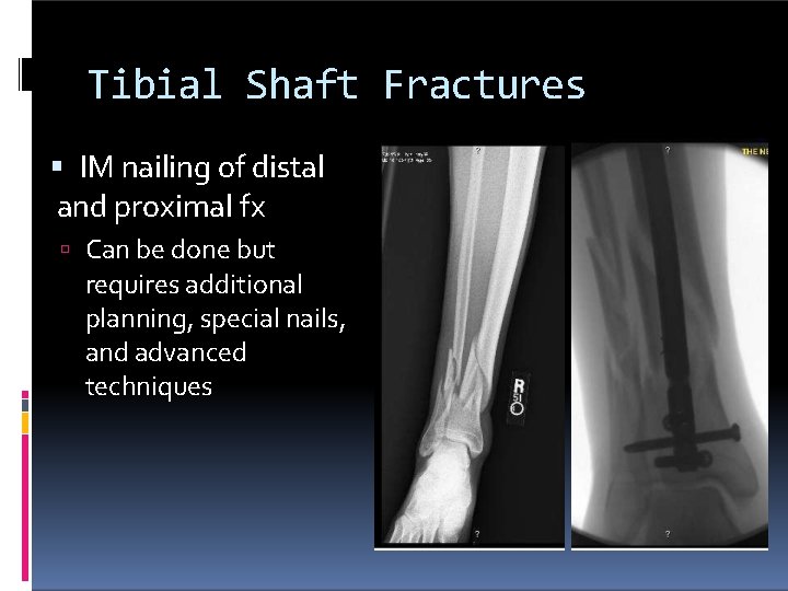 Tibial Shaft Fractures IM nailing of distal and proximal fx Can be done but