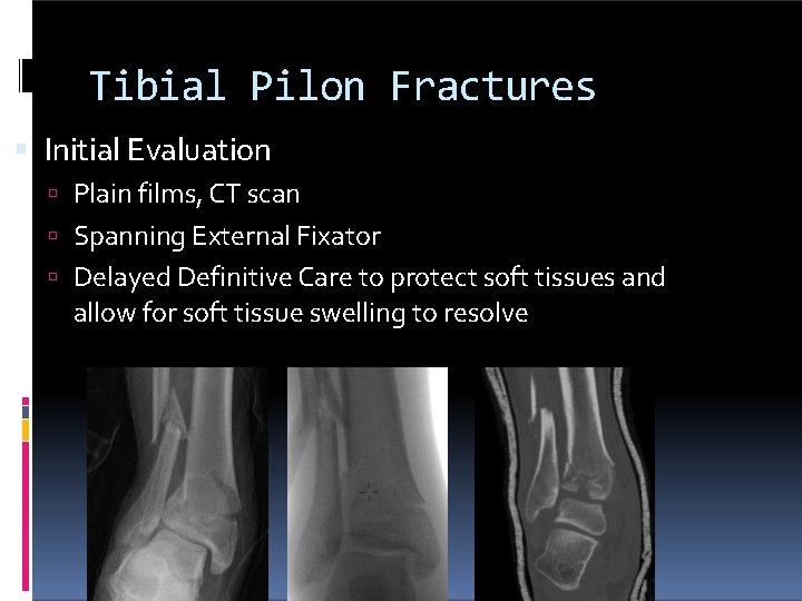 Tibial Pilon Fractures Initial Evaluation Plain films, CT scan Spanning External Fixator Delayed Definitive