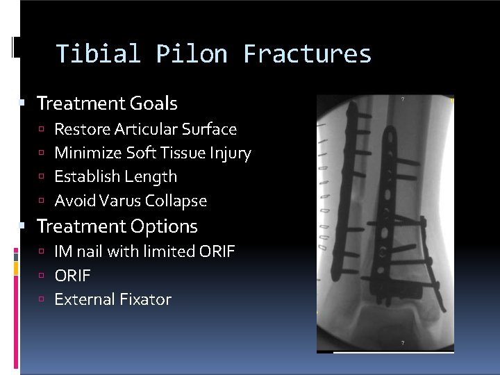 Tibial Pilon Fractures Treatment Goals Restore Articular Surface Minimize Soft Tissue Injury Establish Length