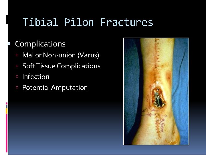 Tibial Pilon Fractures Complications Mal or Non-union (Varus) Soft Tissue Complications Infection Potential Amputation