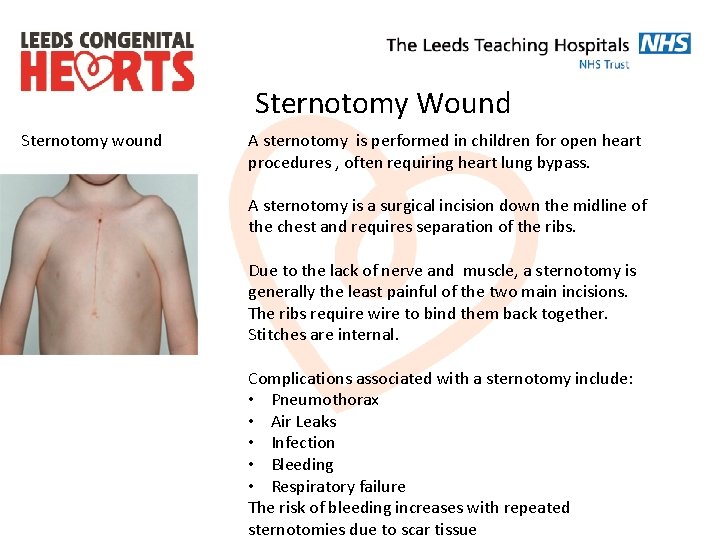 Sternotomy Wound Sternotomy wound A sternotomy is performed in children for open heart procedures