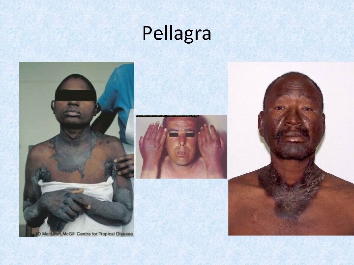 Pellagra 