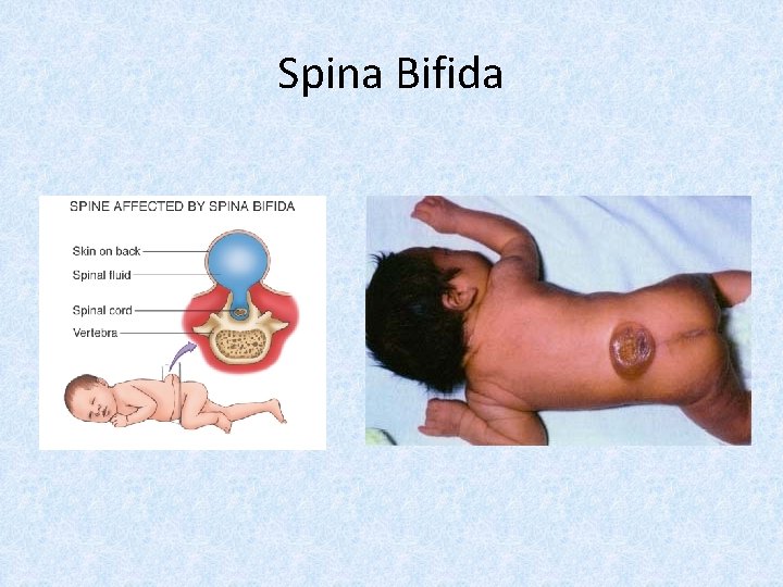 Spina Bifida 