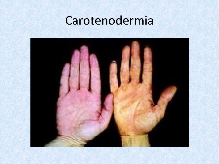 Carotenodermia 