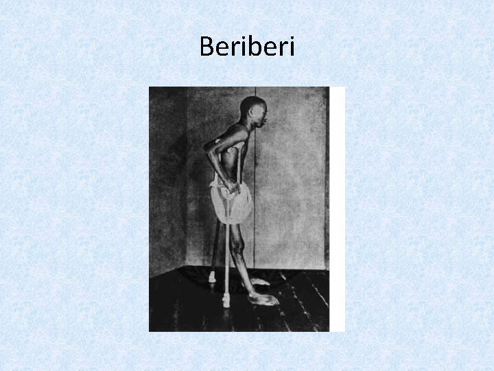 Beriberi 