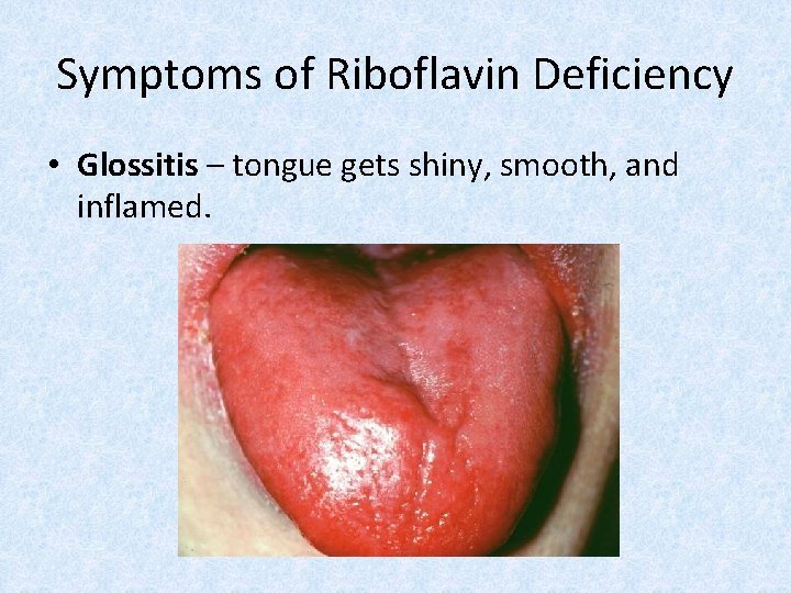 Symptoms of Riboflavin Deficiency • Glossitis – tongue gets shiny, smooth, and inflamed. 