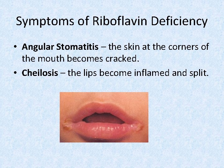 Symptoms of Riboflavin Deficiency • Angular Stomatitis – the skin at the corners of