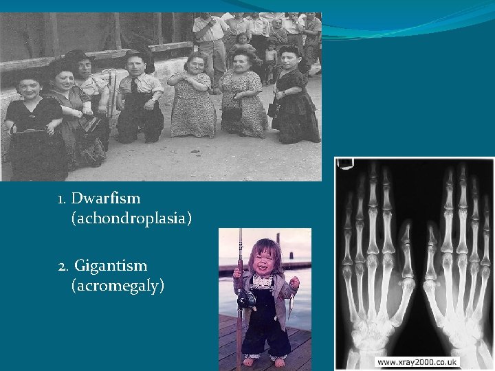 1. Dwarfism (achondroplasia) 2. Gigantism (acromegaly) 