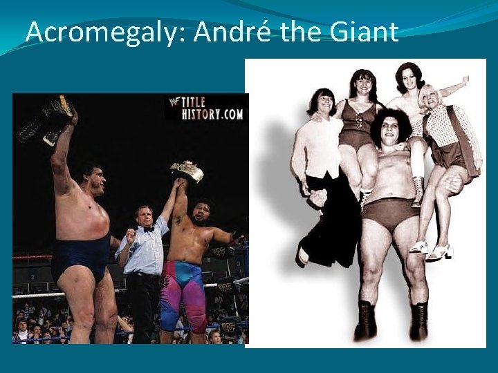 Acromegaly: André the Giant 