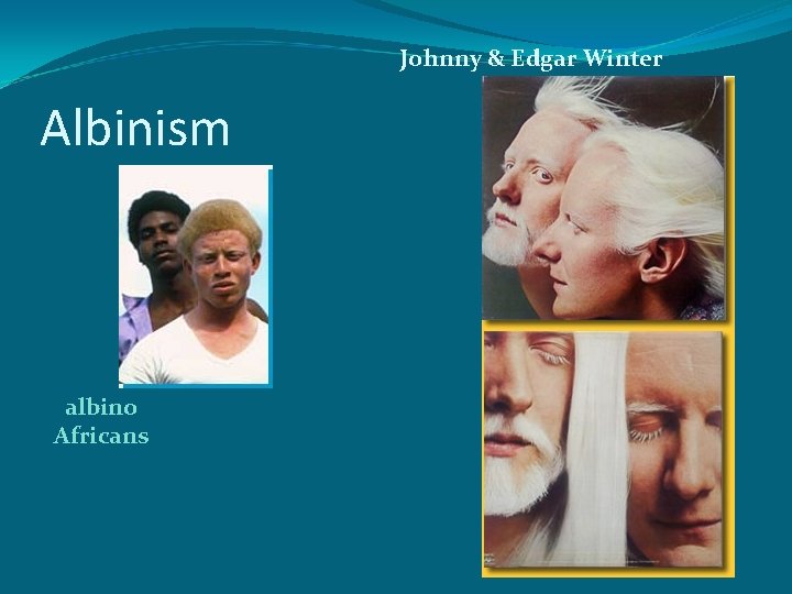 Johnny & Edgar Winter Albinism albino Africans 