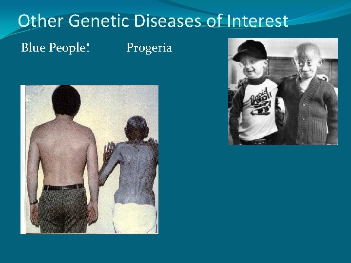 Other Genetic Diseases of Interest Blue People! Progeria 