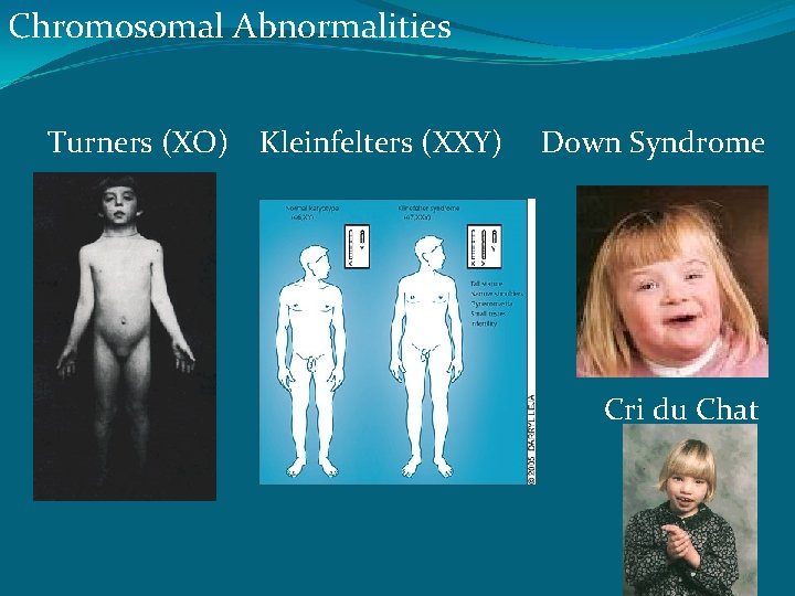 Chromosomal Abnormalities Turners (XO) Kleinfelters (XXY) Down Syndrome Cri du Chat 