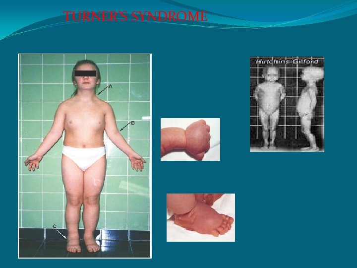 TURNER’S SYNDROME 