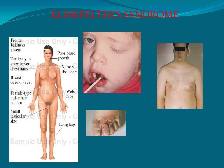 KLINEFELTER’S SYNDROME 