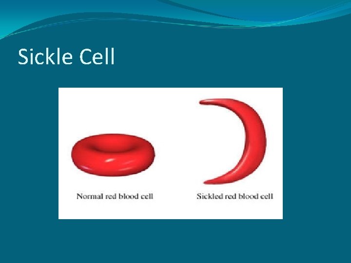 Sickle Cell 
