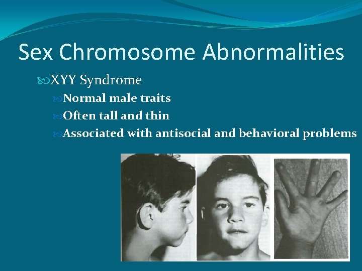 Sex Chromosome Abnormalities XYY Syndrome Normal male traits Often tall and thin Associated with