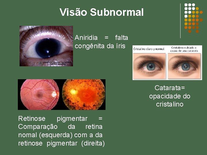 Visão Subnormal Aniridia = falta congênita da íris Catarata= opacidade do cristalino Retinose pigmentar