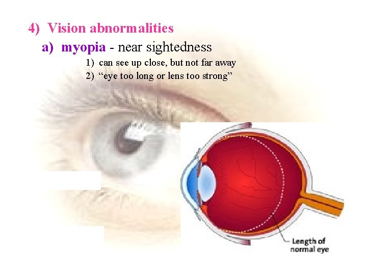 4) Vision abnormalities a) myopia - near sightedness 1) can see up close, but