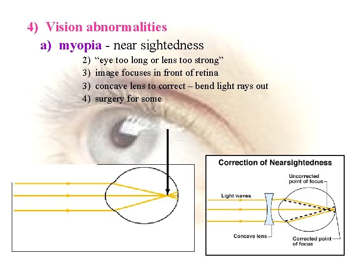4) Vision abnormalities a) myopia - near sightedness 2) 3) 3) 4) “eye too