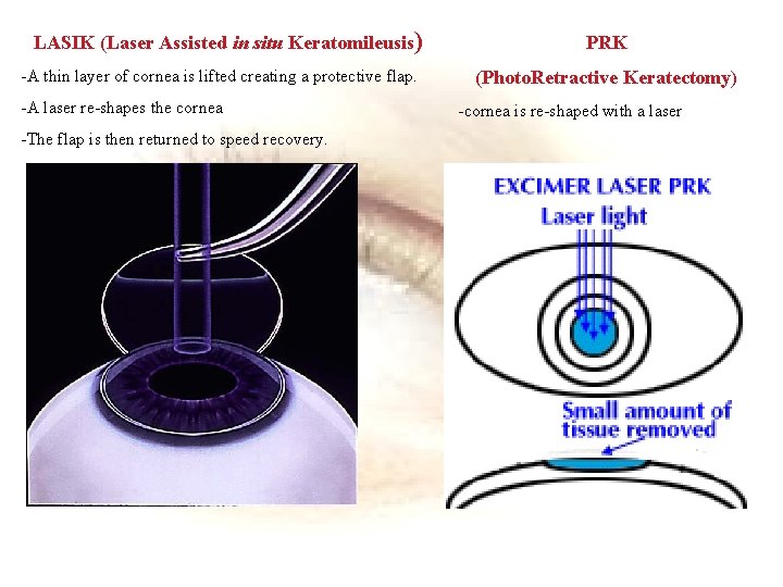 LASIK (Laser Assisted in situ Keratomileusis) -A thin layer of cornea is lifted creating