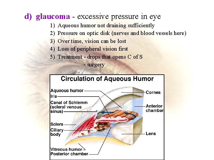 d) glaucoma - excessive pressure in eye 1) 2) 3) 4) 5) Aqueous humor