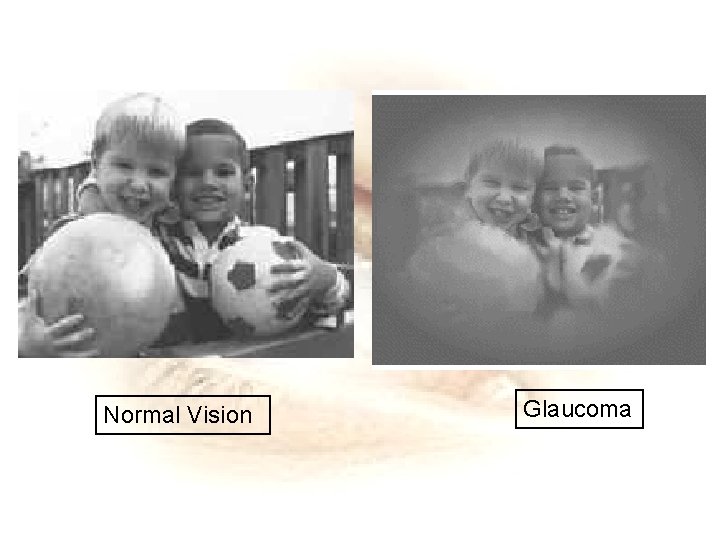 Normal Vision Glaucoma 