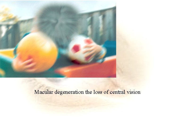 Macular degeneration the loss of central vision 