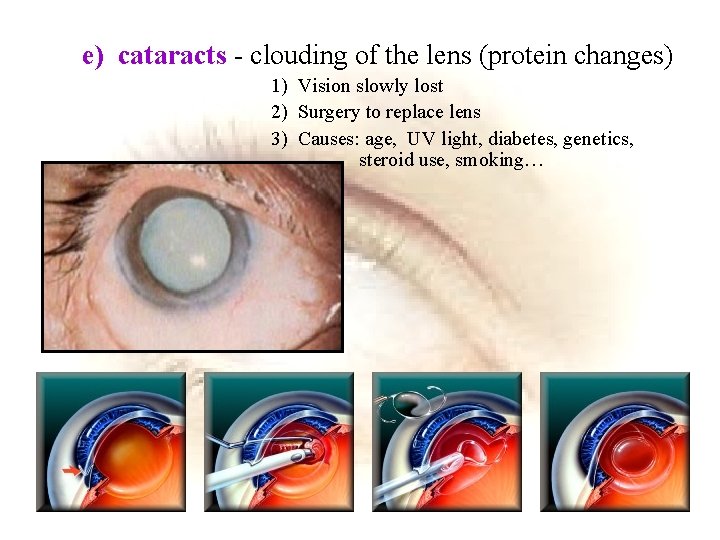 e) cataracts - clouding of the lens (protein changes) 1) Vision slowly lost 2)