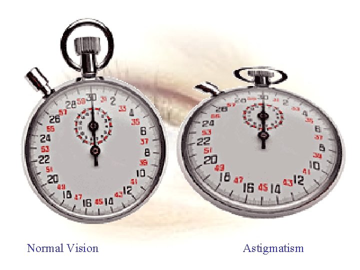  Normal Vision Astigmatism 