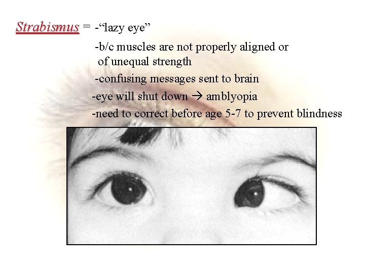 Strabismus = -“lazy eye” -b/c muscles are not properly aligned or of unequal strength