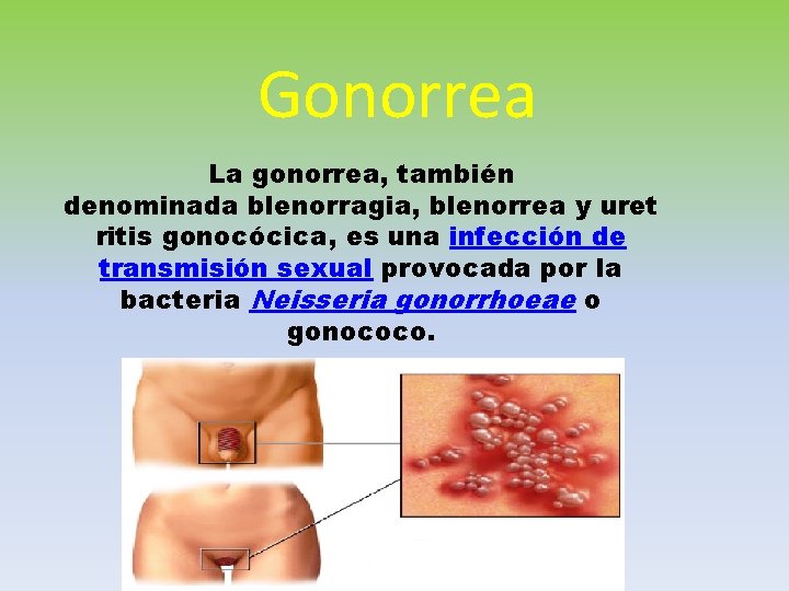 Gonorrea La gonorrea, también denominada blenorragia, blenorrea y uret ritis gonocócica, es una infección