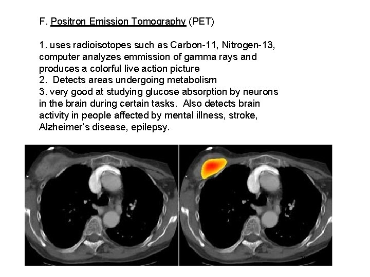 F. Positron Emission Tomography (PET) 1. uses radioisotopes such as Carbon-11, Nitrogen-13, computer analyzes