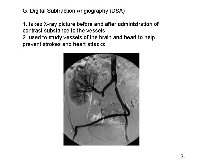 G. Digital Subtraction Angiography (DSA) 1. takes X-ray picture before and after administration of