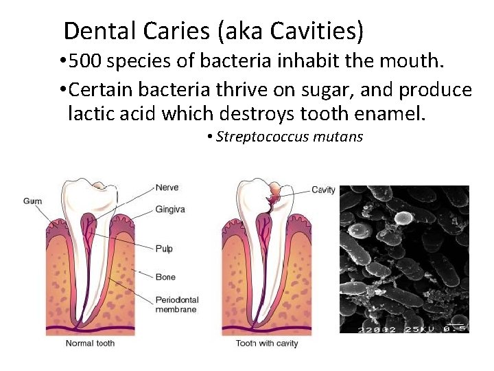 Dental Caries (aka Cavities) • 500 species of bacteria inhabit the mouth. • Certain