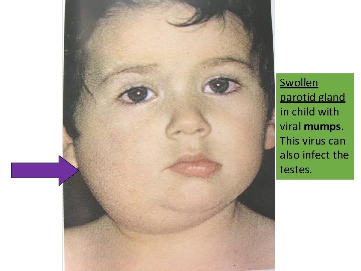 Swollen parotid gland in child with viral mumps. This virus can also infect the