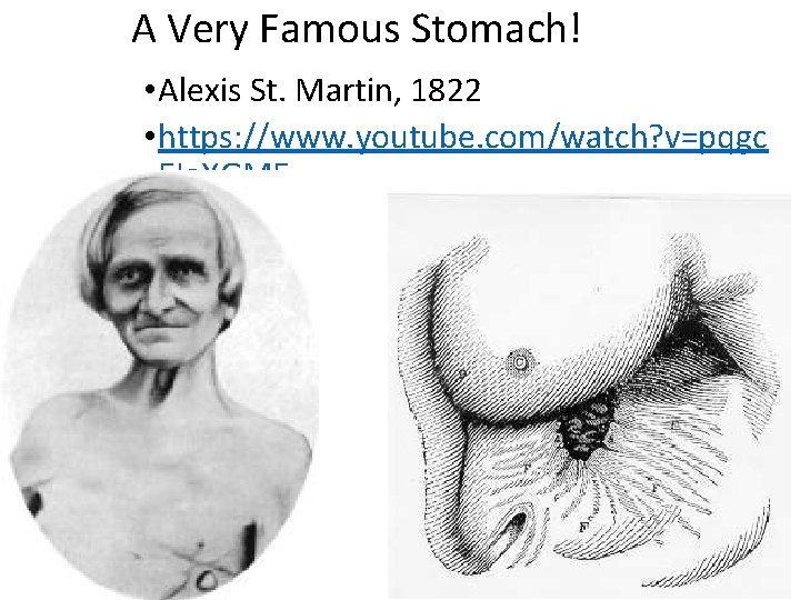 A Very Famous Stomach! • Alexis St. Martin, 1822 • https: //www. youtube. com/watch?