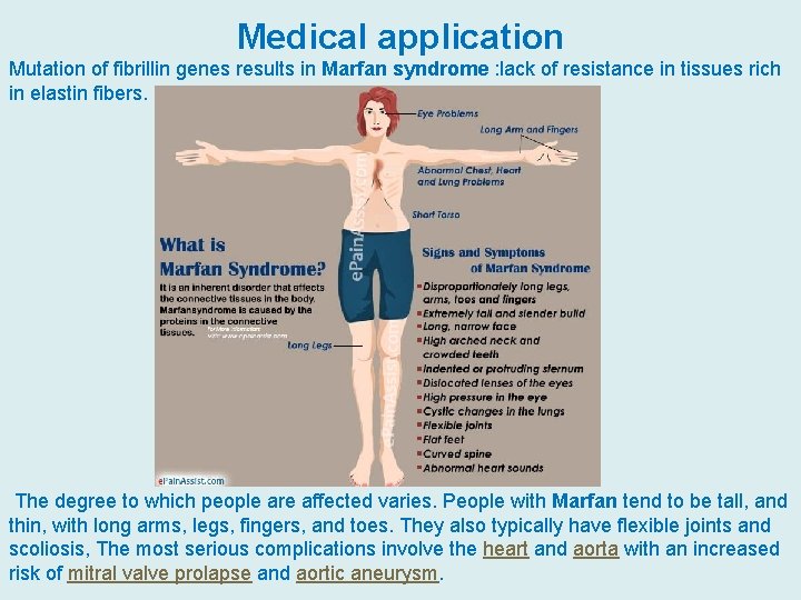 Medical application Mutation of fibrillin genes results in Marfan syndrome : lack of resistance