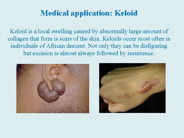 Medical application: Keloid is a local swelling caused by abnormally large amount of collagen