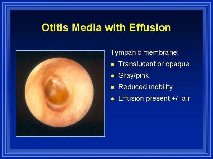 Otitis Media And Eustachian Tube Dysfunction R Kent