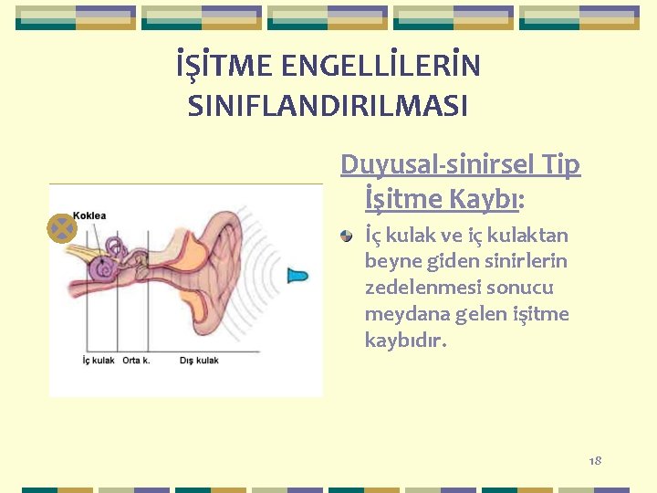 İŞİTME ENGELLİLERİN SINIFLANDIRILMASI Duyusal-sinirsel Tip İşitme Kaybı: İç kulak ve iç kulaktan beyne giden