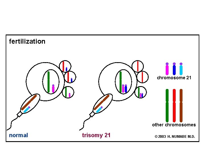 fertilization chromosome 21 other chromosomes normal trisomy 21 © 2003 H. NUMABE M. D.